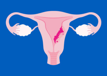 Cáncer de endometrio: el enemigo silencioso que afecta a miles de mujeres cada año