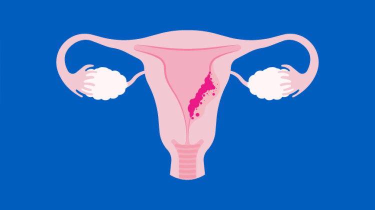 Cáncer de endometrio: el enemigo silencioso que afecta a miles de mujeres cada año