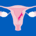 Cáncer de endometrio: el enemigo silencioso que afecta a miles de mujeres cada año