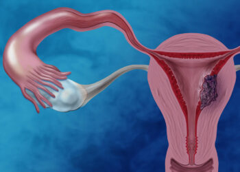 Cáncer de endometrio: el enemigo silencioso que afecta a miles de mujeres cada año