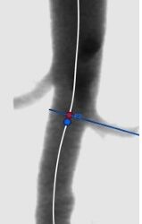 Aneurisma aórtico abdominal, amenaza silenciosa y desconocida potencialmente mortal