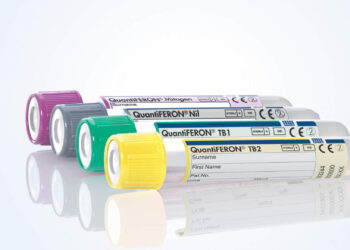 Necesario, fortalecer la detección oportuna de la tuberculosis latente