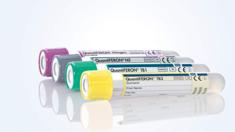 Necesario, fortalecer la detección oportuna de la tuberculosis latente