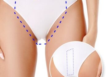 Tecnología YAG Candela facilita depilacion bikini brasileño en Kopay de Gele Giner