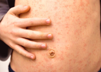 Confirman 4 mil 353 casos y 17 muertes por sarampión en México