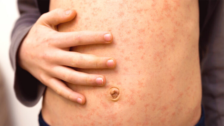 Confirman 4 mil 353 casos y 17 muertes por sarampión en México